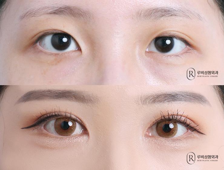 Natural adhesion, ptosis correction, epicanthoplasty