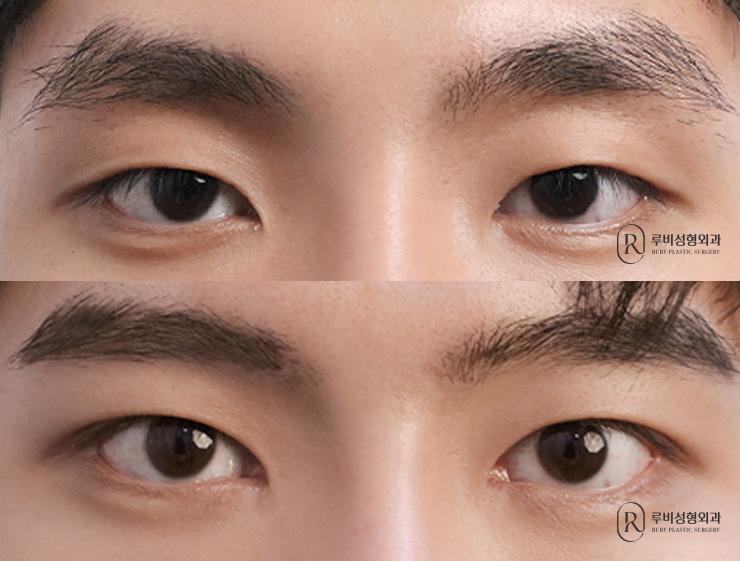 Men's natural adhesion, ptosis correction, epicanthoplasty