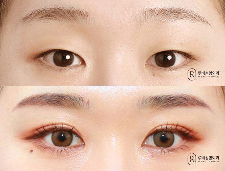 Natural adhesion, ptosis correction
