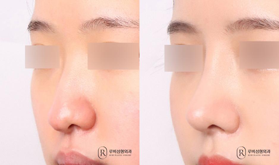 Nasal bridge, nasal tip, long nose correction, bulbous nose correction