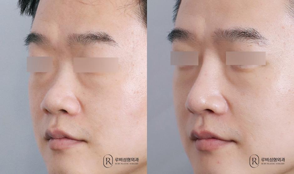 Nasal bridge, nasal tip, alar cinching