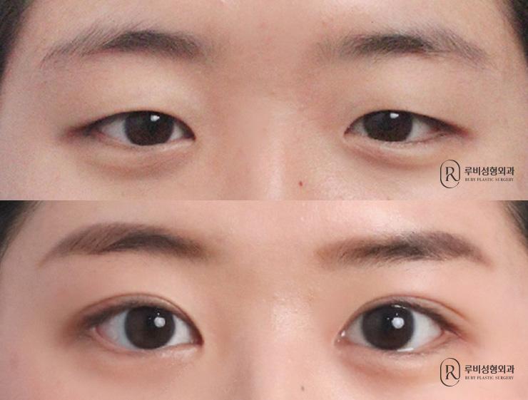 Natural adhesion, ptosis correction, epicanthoplasty
