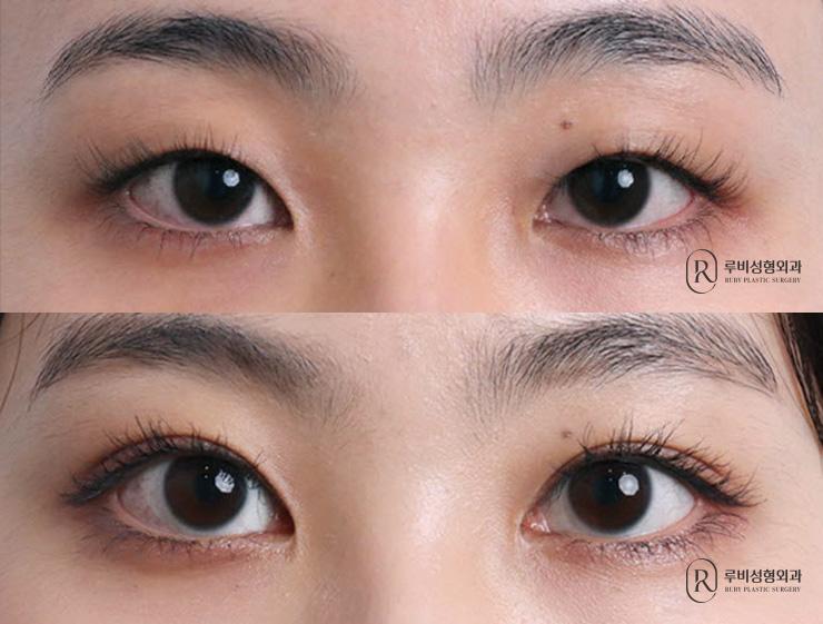 Natural adhesion, ptosis correction, epicanthoplasty