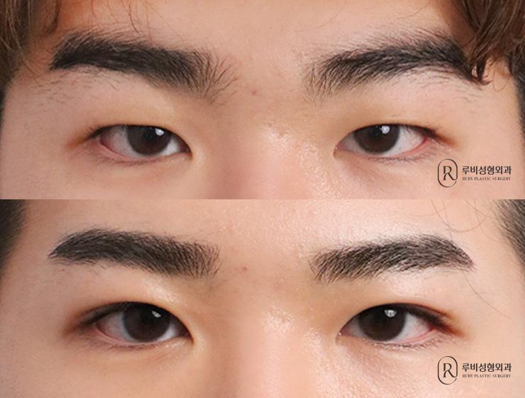 Men's natural adhesion, ptosis correction