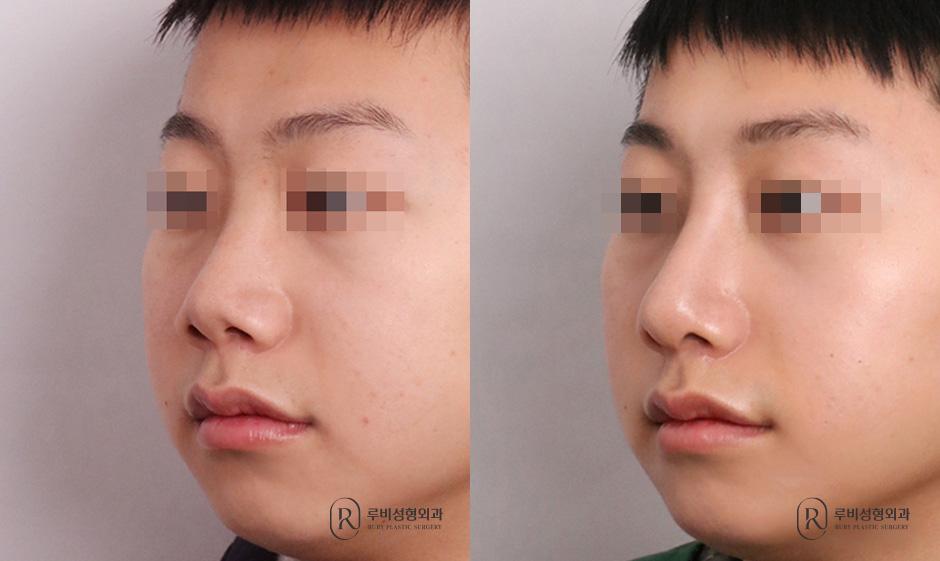 Nasal bridge, nasal tip, short nose correction, alar cinching
