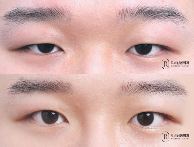 Men's natural adhesion, ptosis correction