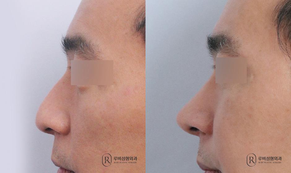 Nose bridge, nose tip, humpectomy, long nose correction