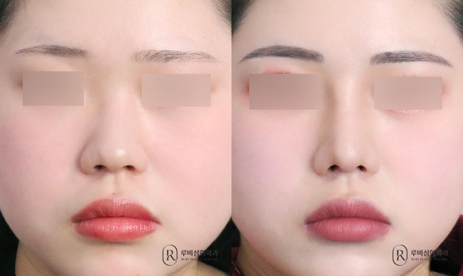 Nasal bridge, nasal tip