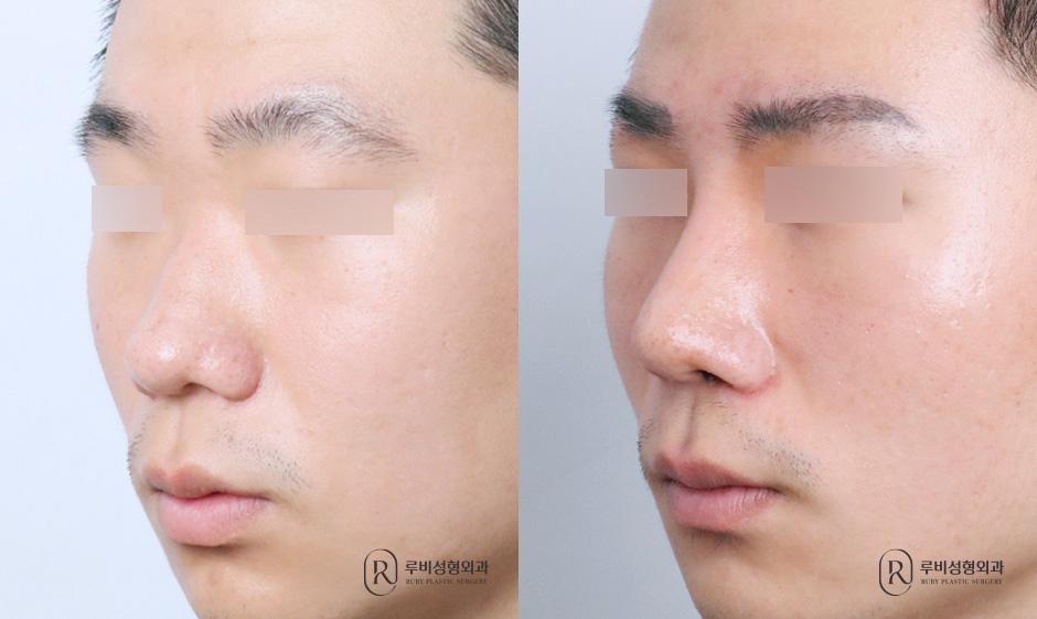 Nasal bridge, nasal tip, short nose correction, bulbous nose correction, alar cinching