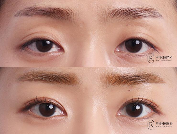 Natural adhesion, ptosis correction