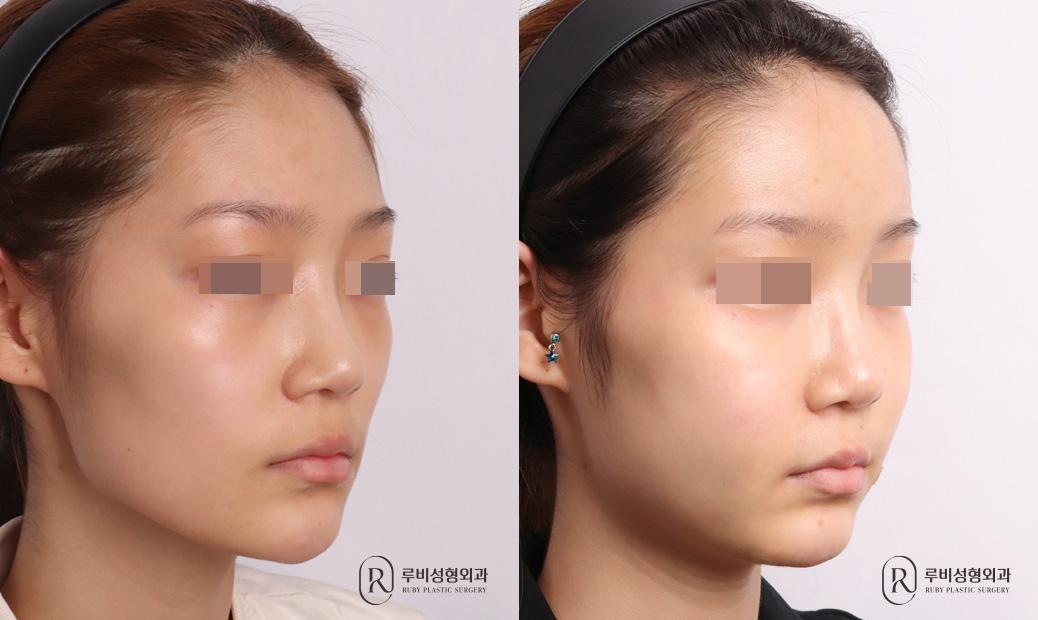 Face Fat Graft