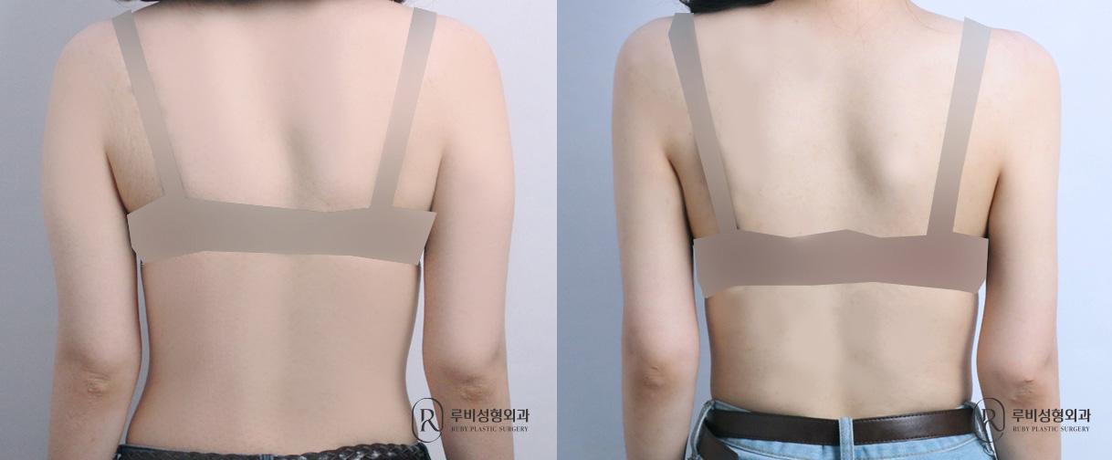 Arm Liposuction