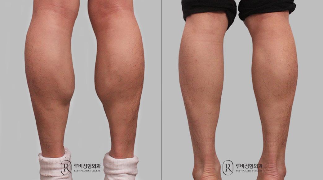 Calf Reduction