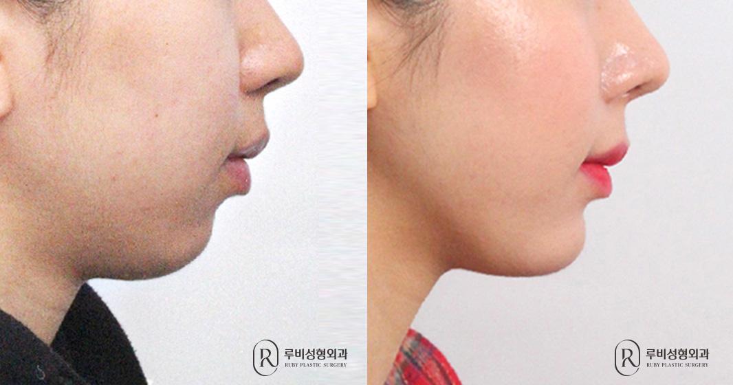 턱보형물