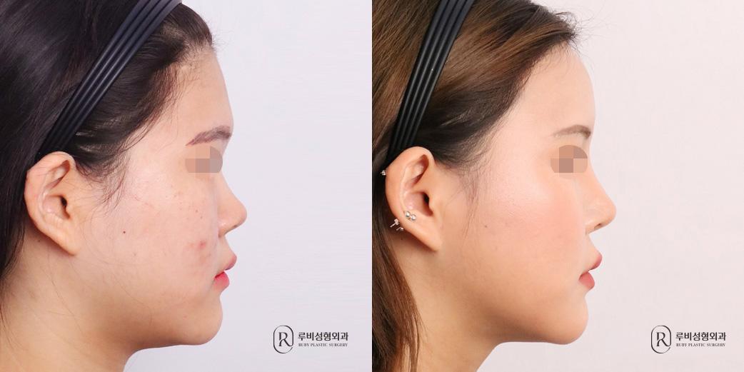 Face Fat Graft
