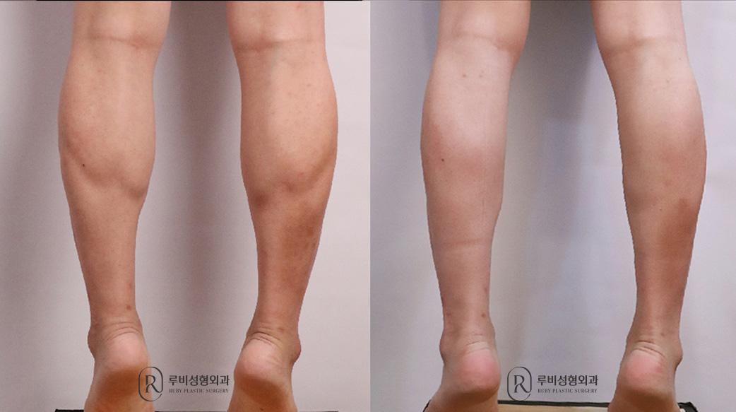 Calf Reduction
