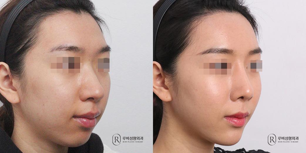 Face Fat Graft