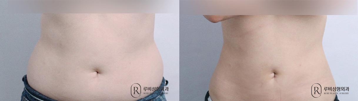 Abdomen and Flank Liposuction