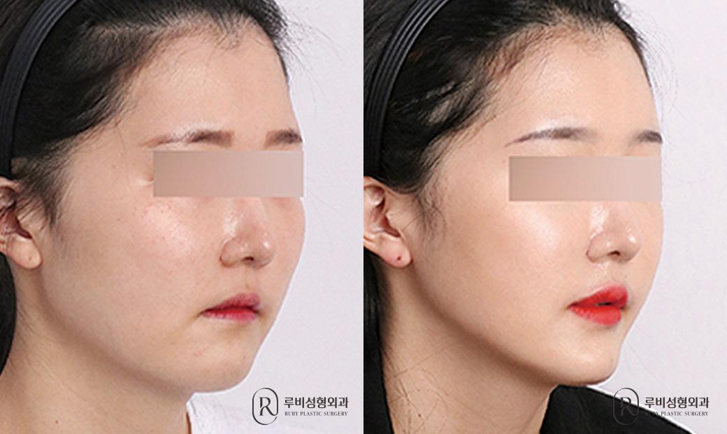 사각턱, 광대, 피질절골