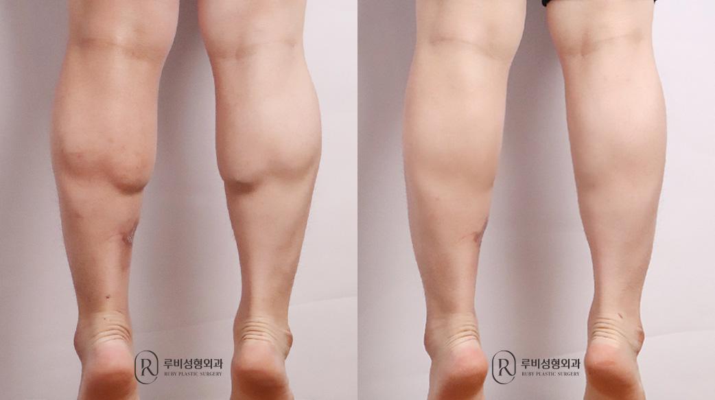 Calf Reduction