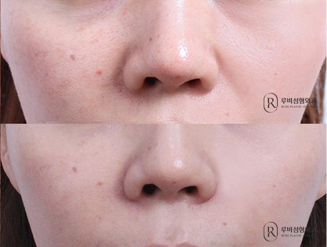 Paranasal augmentation