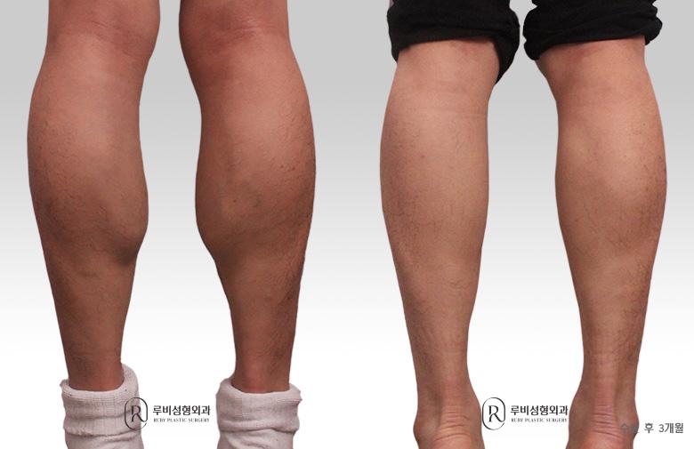 Men's calf contouring (nerve block)