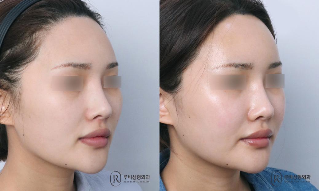 Face Fat Graft