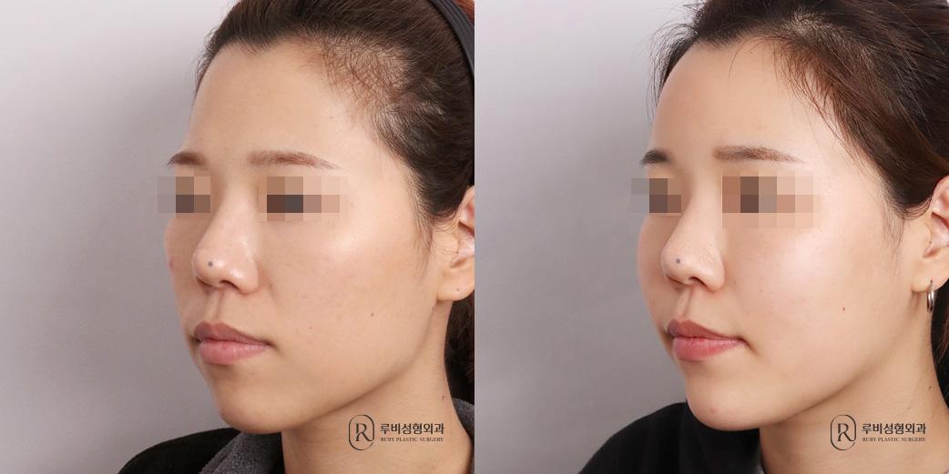 Face Fat Graft