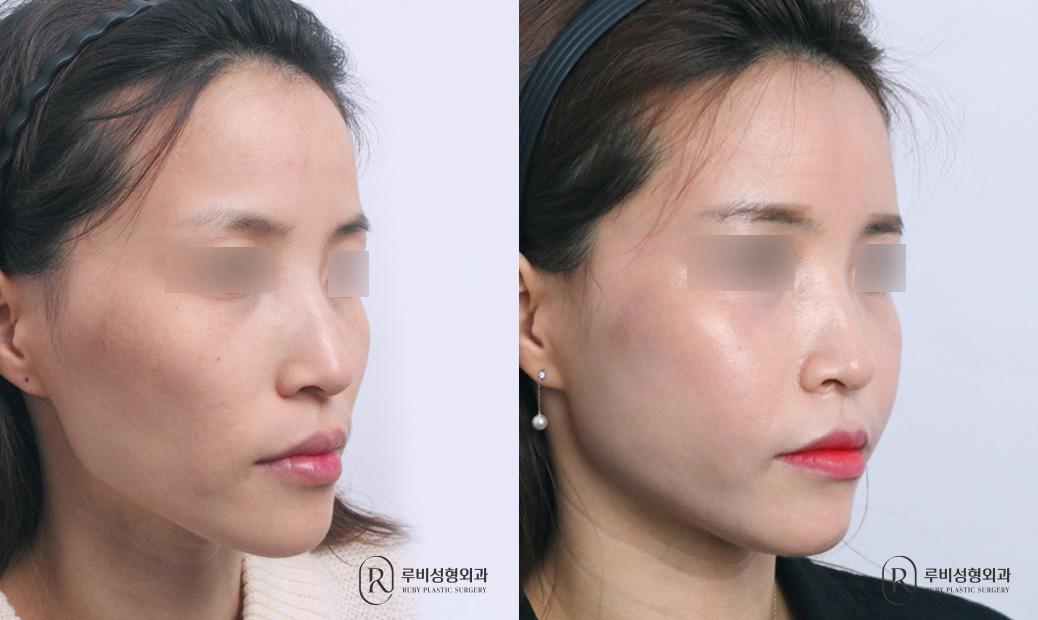 Face Fat Graft