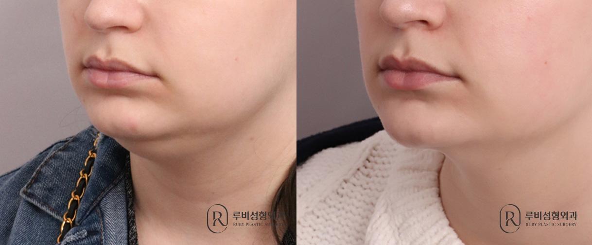Neck lift