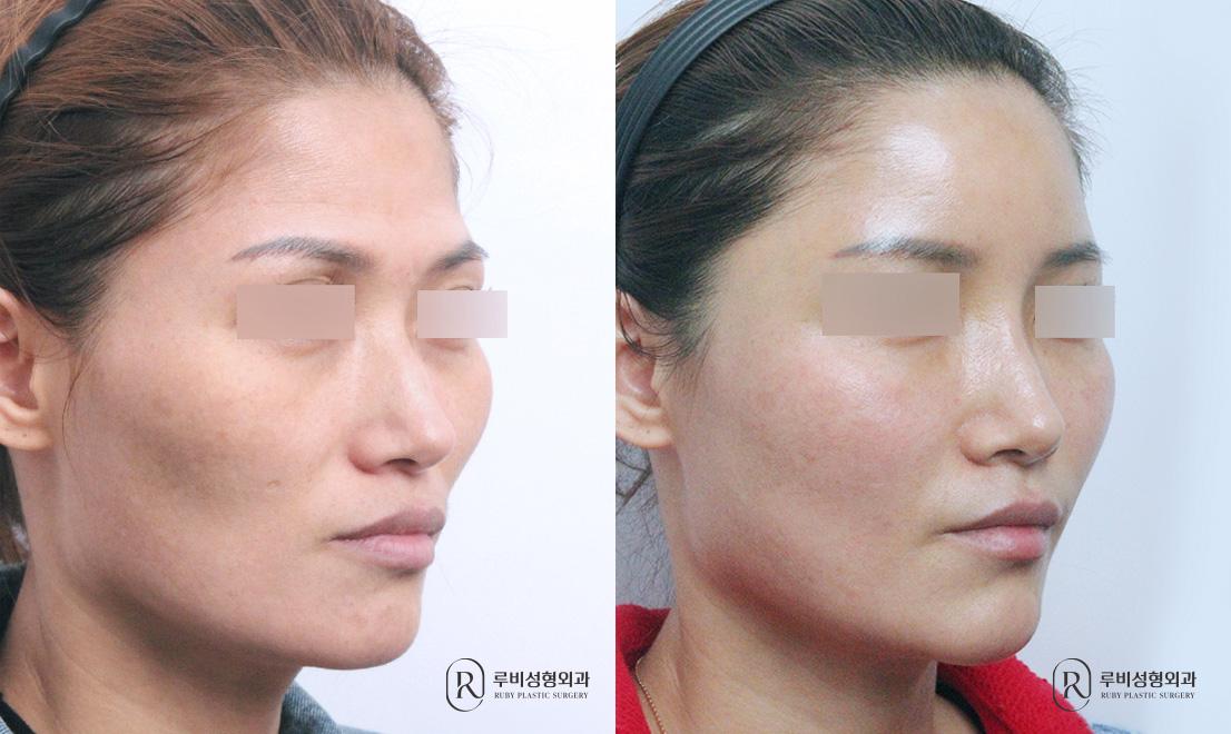Face Fat Graft