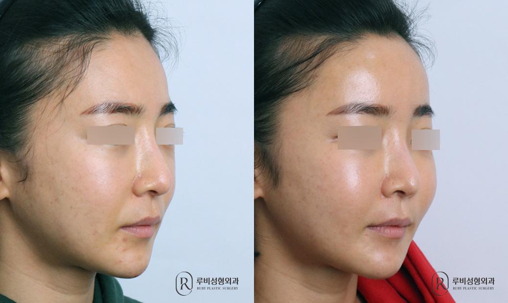 Face Fat Graft