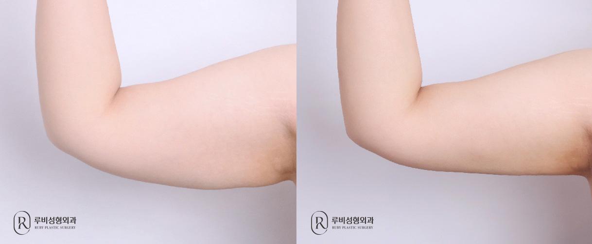 Arm Liposuction