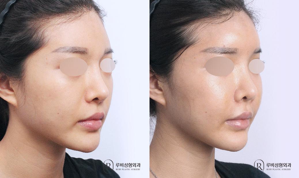 Face Fat Graft