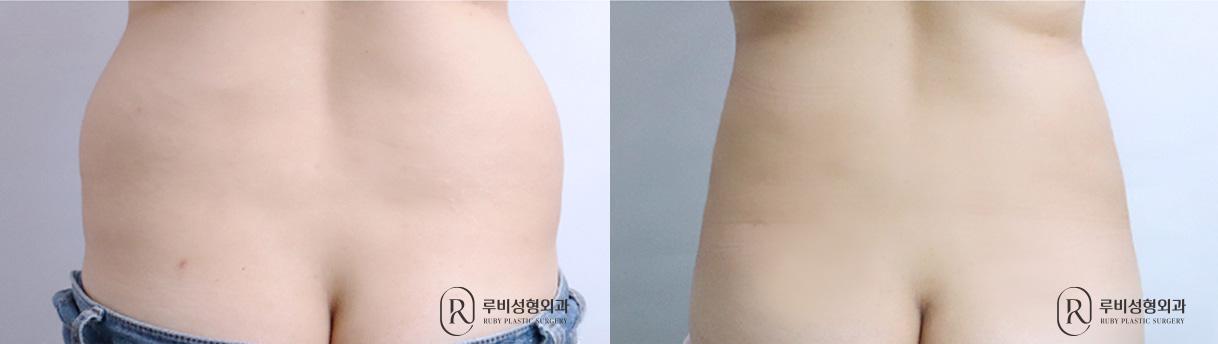 Abdomen and Flank Liposuction