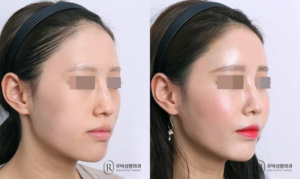Face Fat Graft
