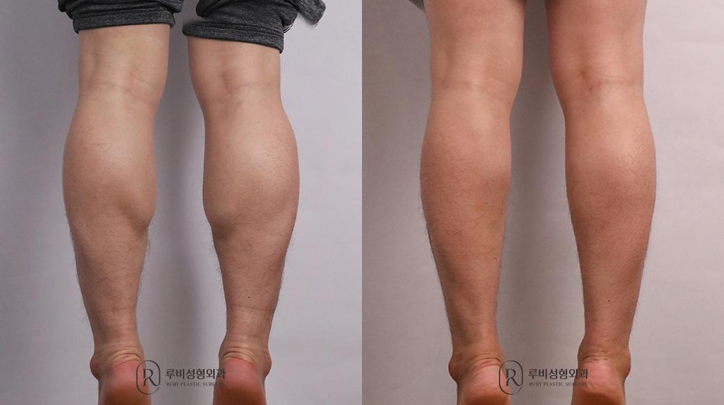 Calf Reduction