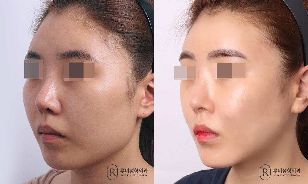 사각턱, 광대축소, 앞턱