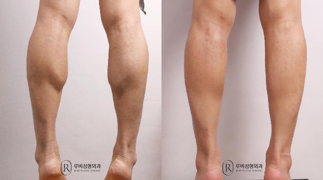 Calf Reduction