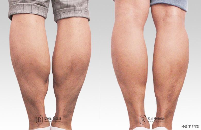 Men's calf contouring (nerve block)