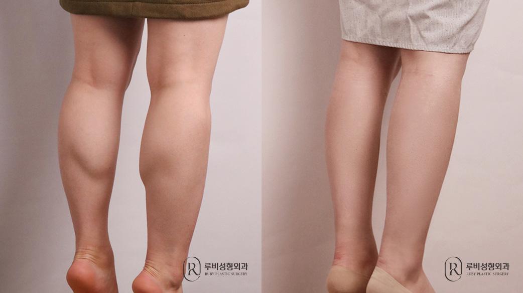 Calf Reduction