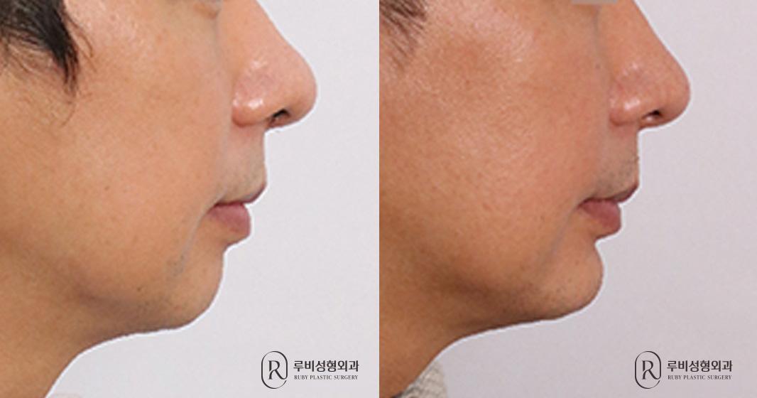 턱보형물