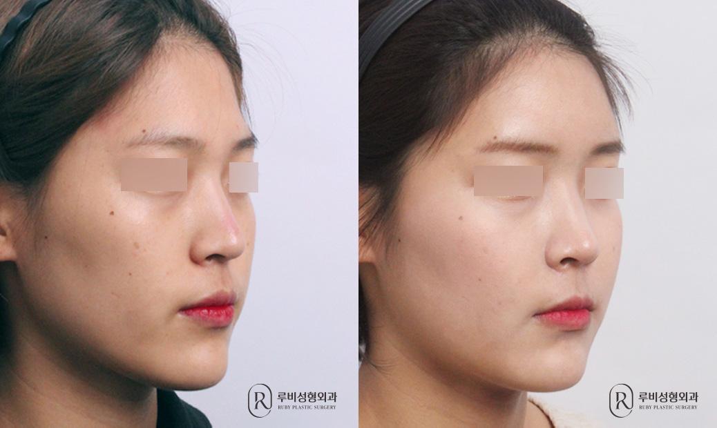 Face Fat Graft