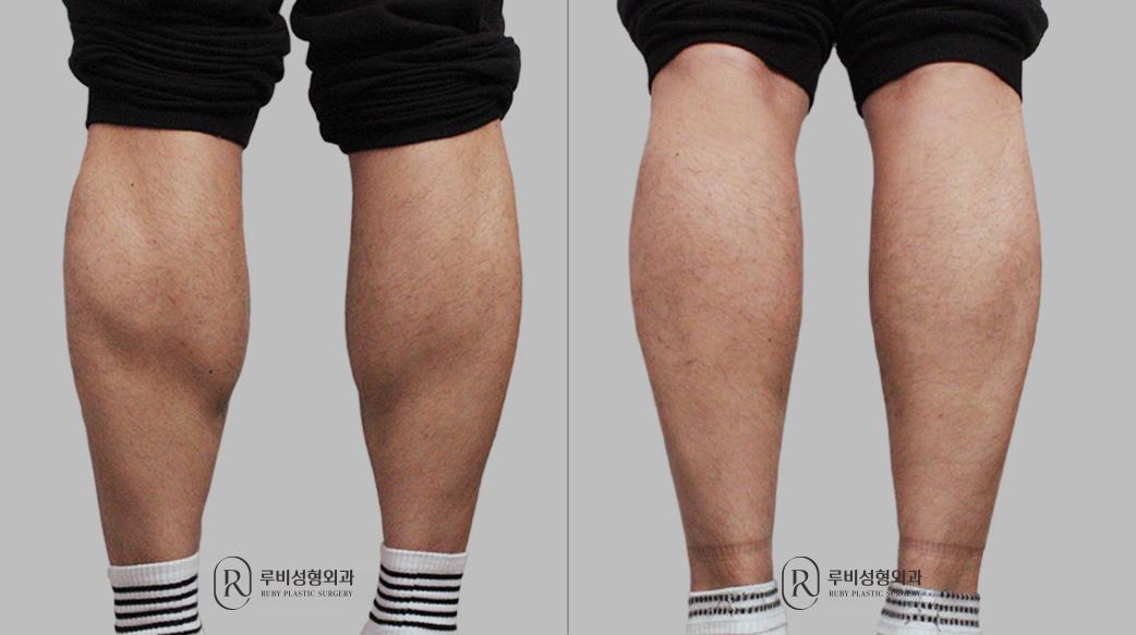 Calf Reduction