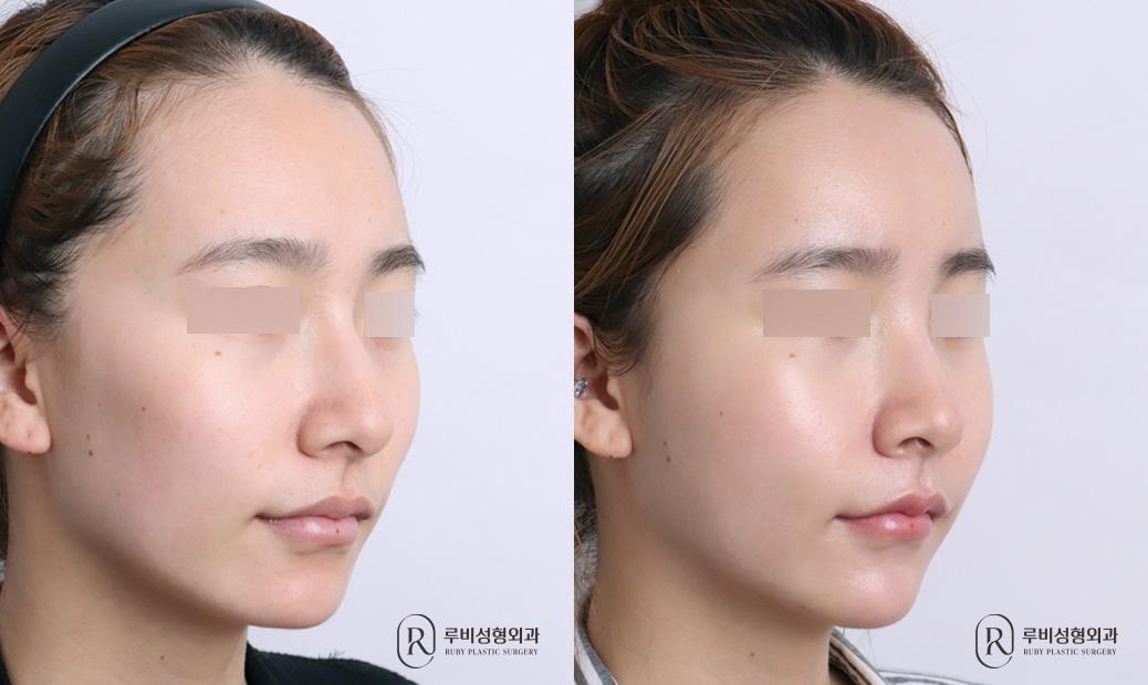 Face Fat Graft