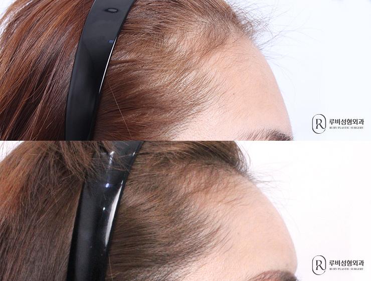 Forehead fat graft