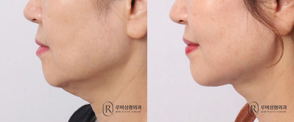 Neck lift