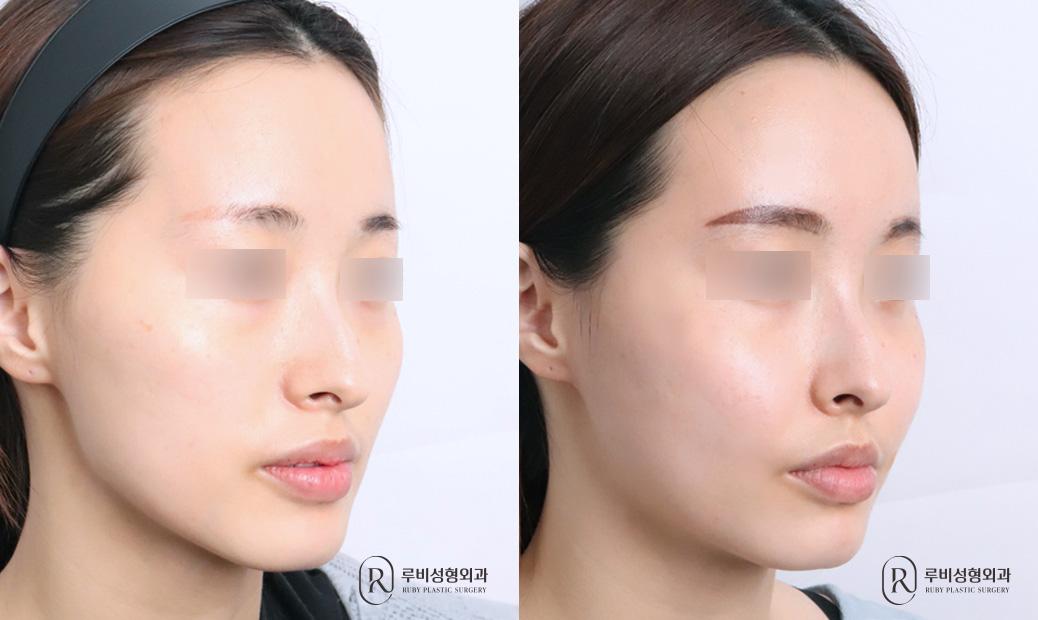 Face Fat Graft