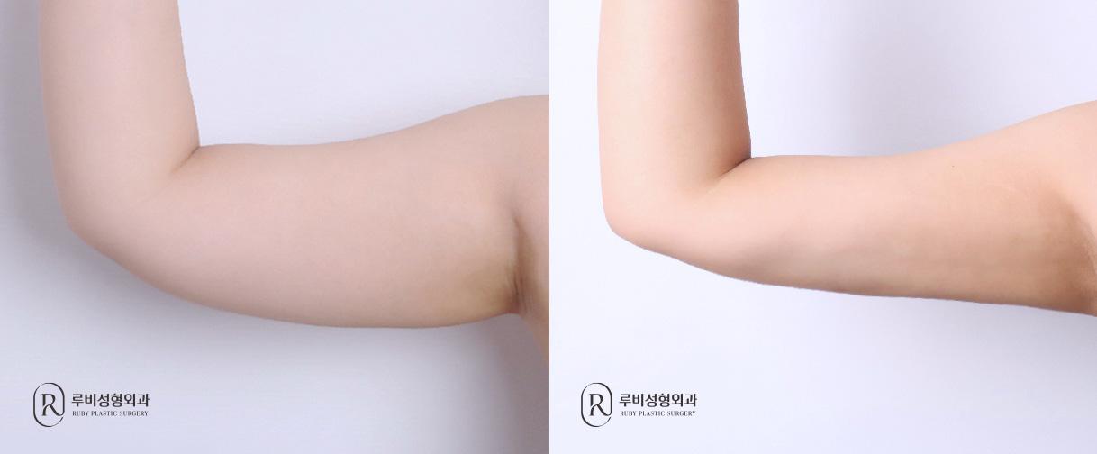 Arm Liposuction