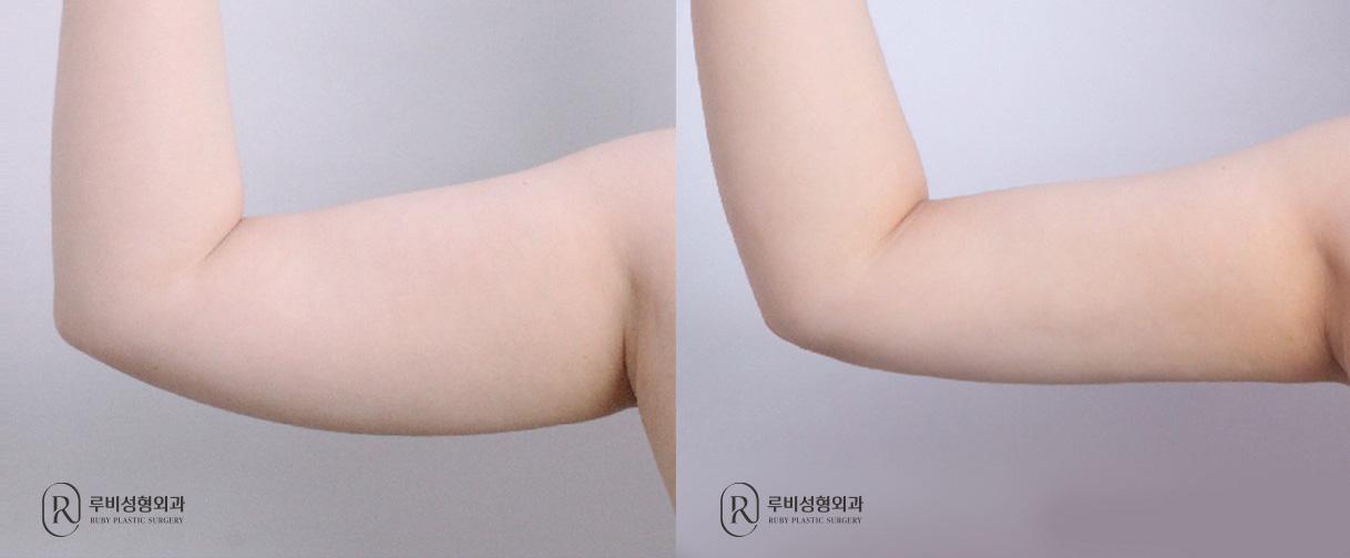 Arm Liposuction